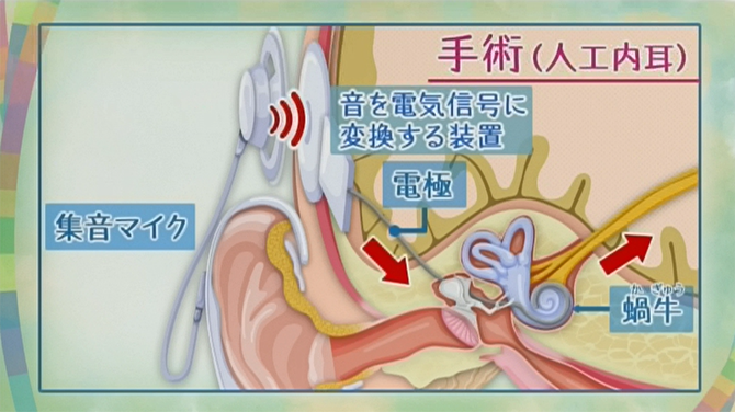 耳の聞こえを改善する手術（人工内耳）