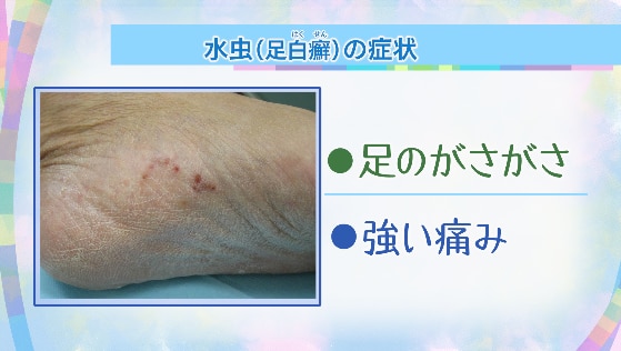 足白癬（あしはくせん）　足のがさがさや強い痛み