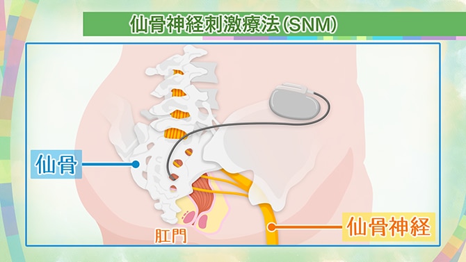 過活動膀胱の新しい治療「仙骨神経刺激療法（SNM）」