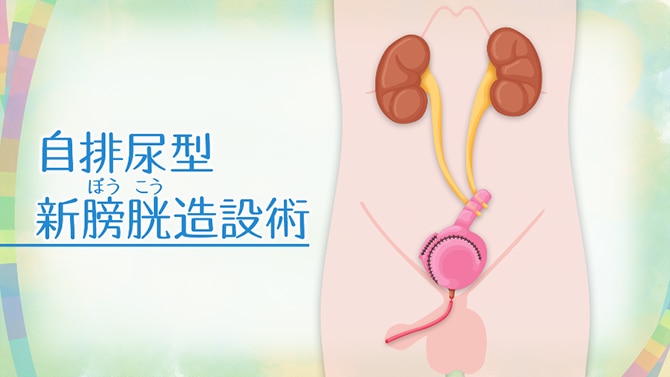 体の中に膀胱の代わりをつくる「自排尿型新膀胱造設術」