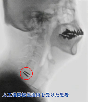 人口椎間板置換手術を受けた患者のレントゲン