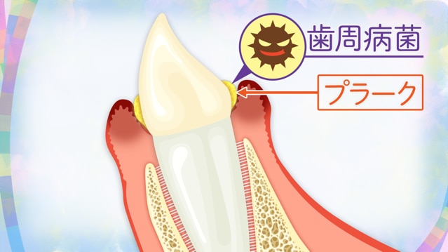 プラークが歯肉の境目から侵入