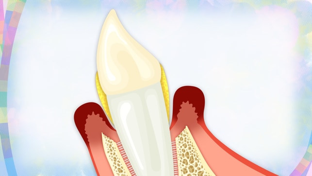 歯を支える歯槽骨が溶けて、歯の支えが失われてしまう