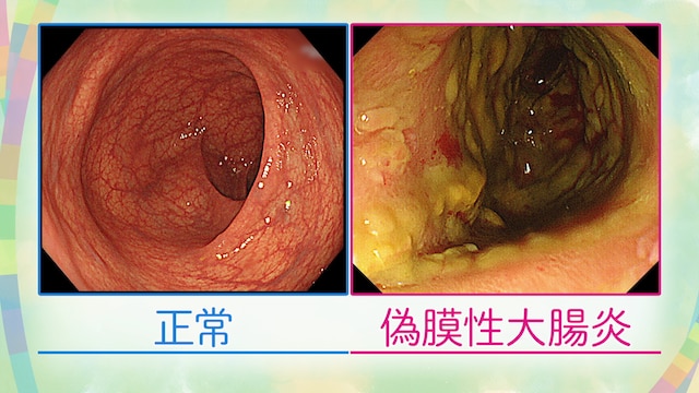 正常な場合と偽膜性大腸炎の写真