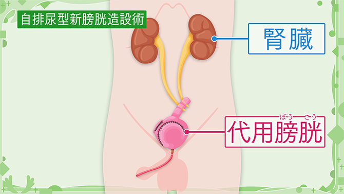 膀胱の代わりをつくる「自排尿型新膀胱造設術」