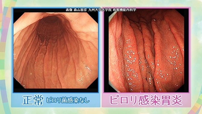 正常な人とピロリ感染胃炎の胃の画像