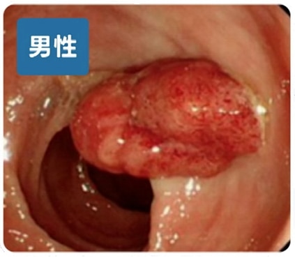男性大腸がん患者の内視鏡画像