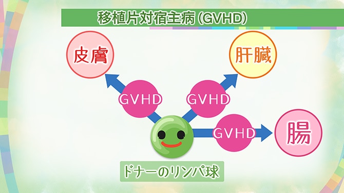 移植片対宿主病（GVHD）について