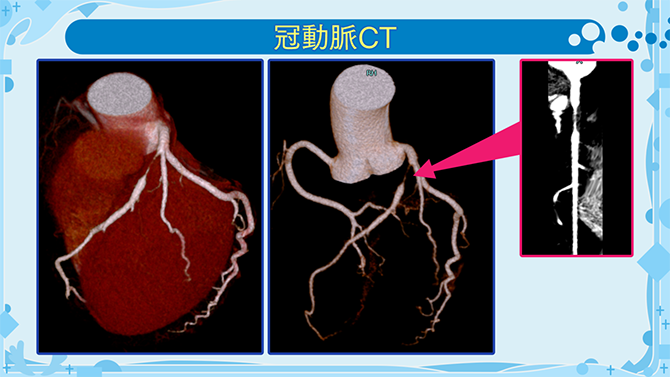 冠動脈CT