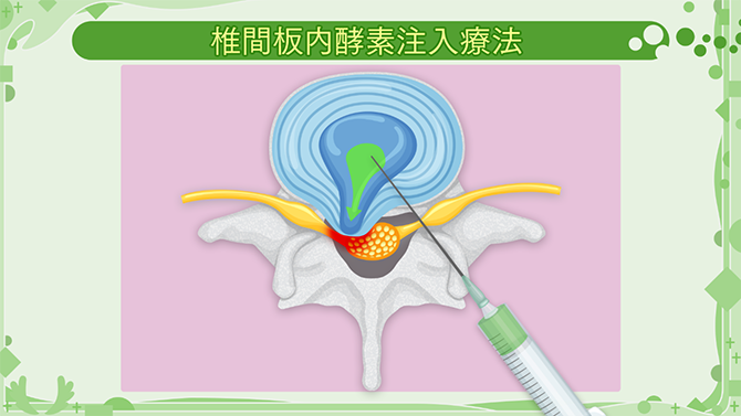 コンドリアーゼという酵素をヘルニアの出ている椎間板の髄核に注入