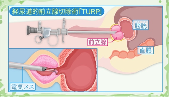 経尿道的前立腺切除術「TURP」