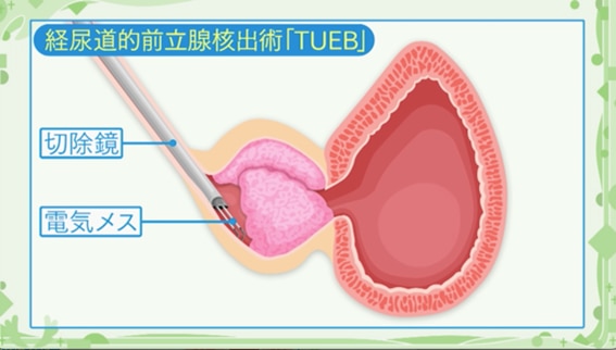 経尿道的前立腺核出術「TUEB」