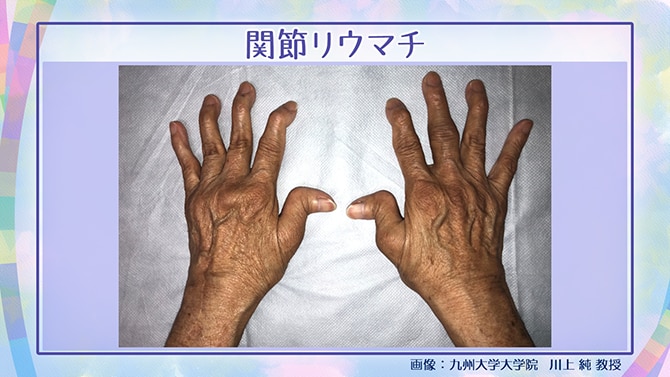 関節リウマチの手