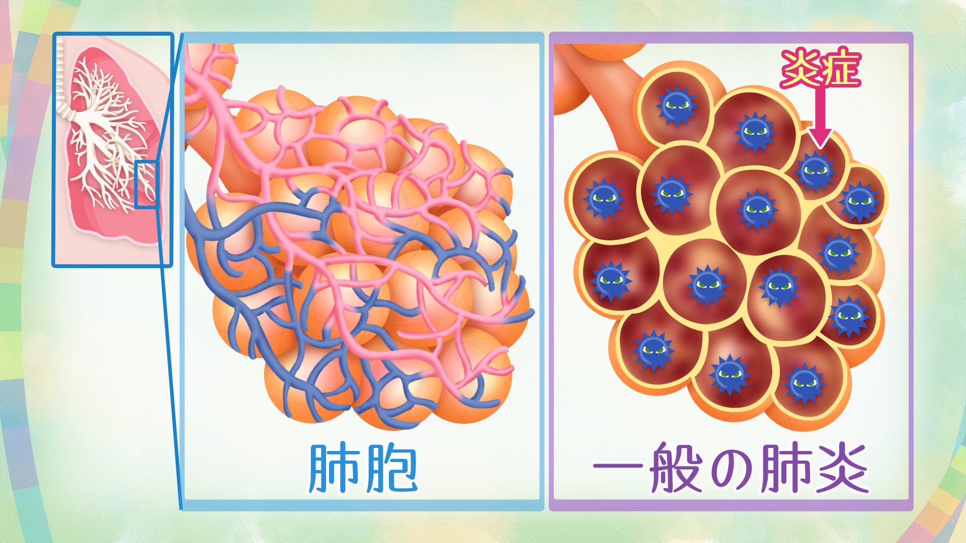 NHK健康チャンネルで確かな医療・健康情報を息切れなどの症状が出る間質性肺炎 治療法や診断、特発性肺線維症について