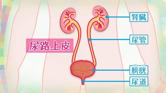 膀胱がんの90％以上は尿路上皮がんというタイプ