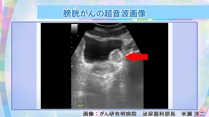 膀胱がんの超音波画像