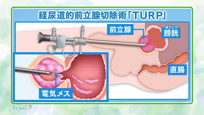 経尿道的前立腺切除術「TURP」
