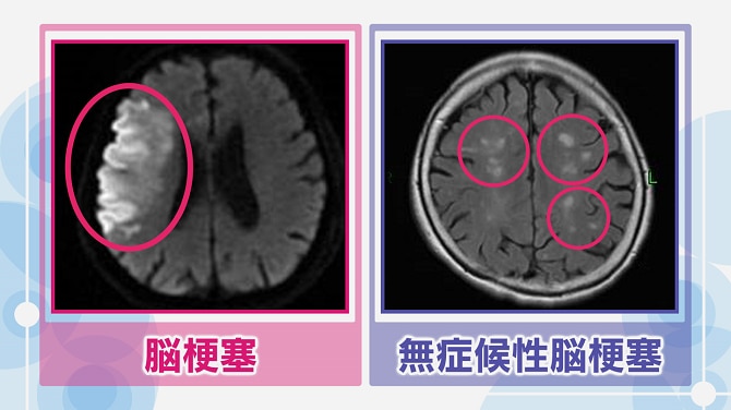 脳梗塞と無症候性脳梗塞の検査画像比較