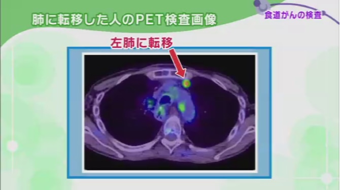 PET検査でがんが左肺に転移していることがわかる写真