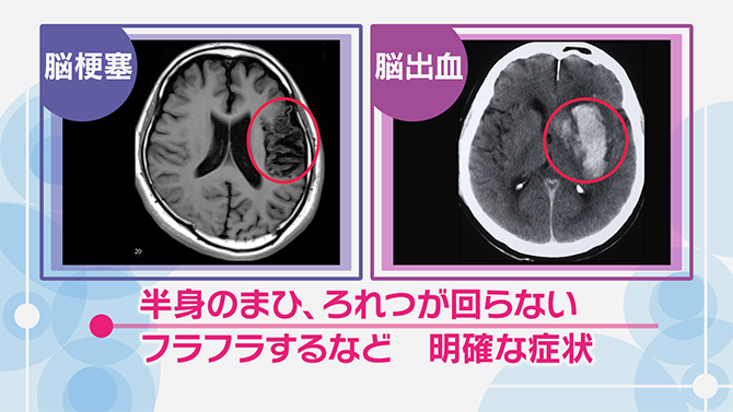 脳梗塞、脳出血の画像と症状