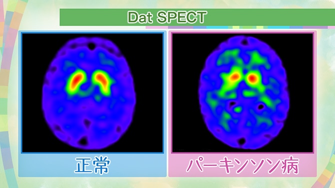 Dat SPECTで見た、正常な人とパーキンソン病の人の脳の画像