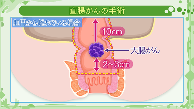 直腸がんで、肛門から離れている場合の手術方法