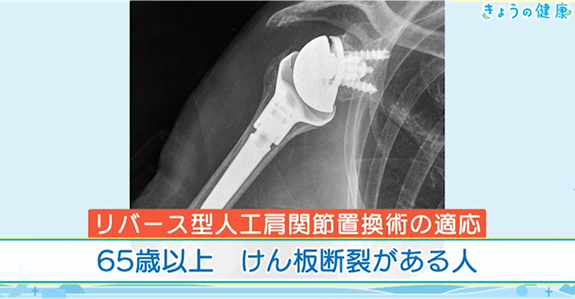 リバース型人工肩関節置換術の適応