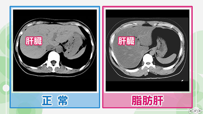 正常な人と脂肪肝の人のMRI画像