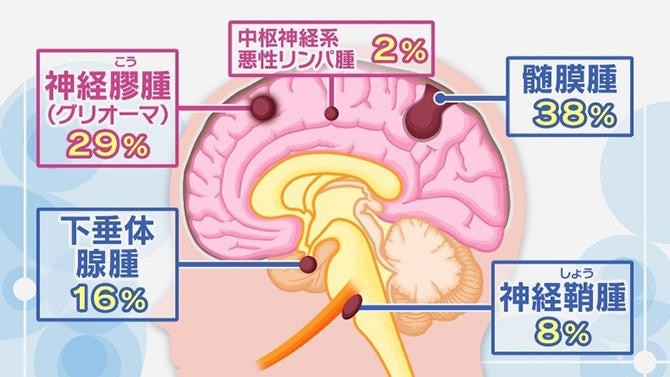 脳腫瘍は原発性脳腫瘍と転移性脳腫瘍に大別される