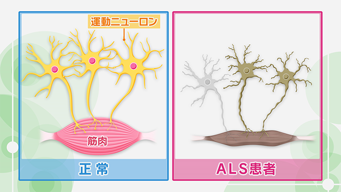 運動ニューロンが正常な場合とALS患者の場合の違いのイラスト