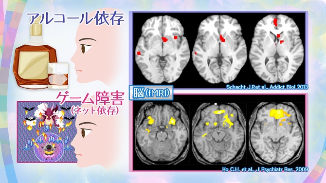 アルコール依存症とゲーム障害の脳のMRI画像