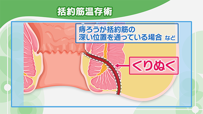 痔ろうとは？男性に多い痔ろうの症状と手術による治療 | NHK健康チャンネル
