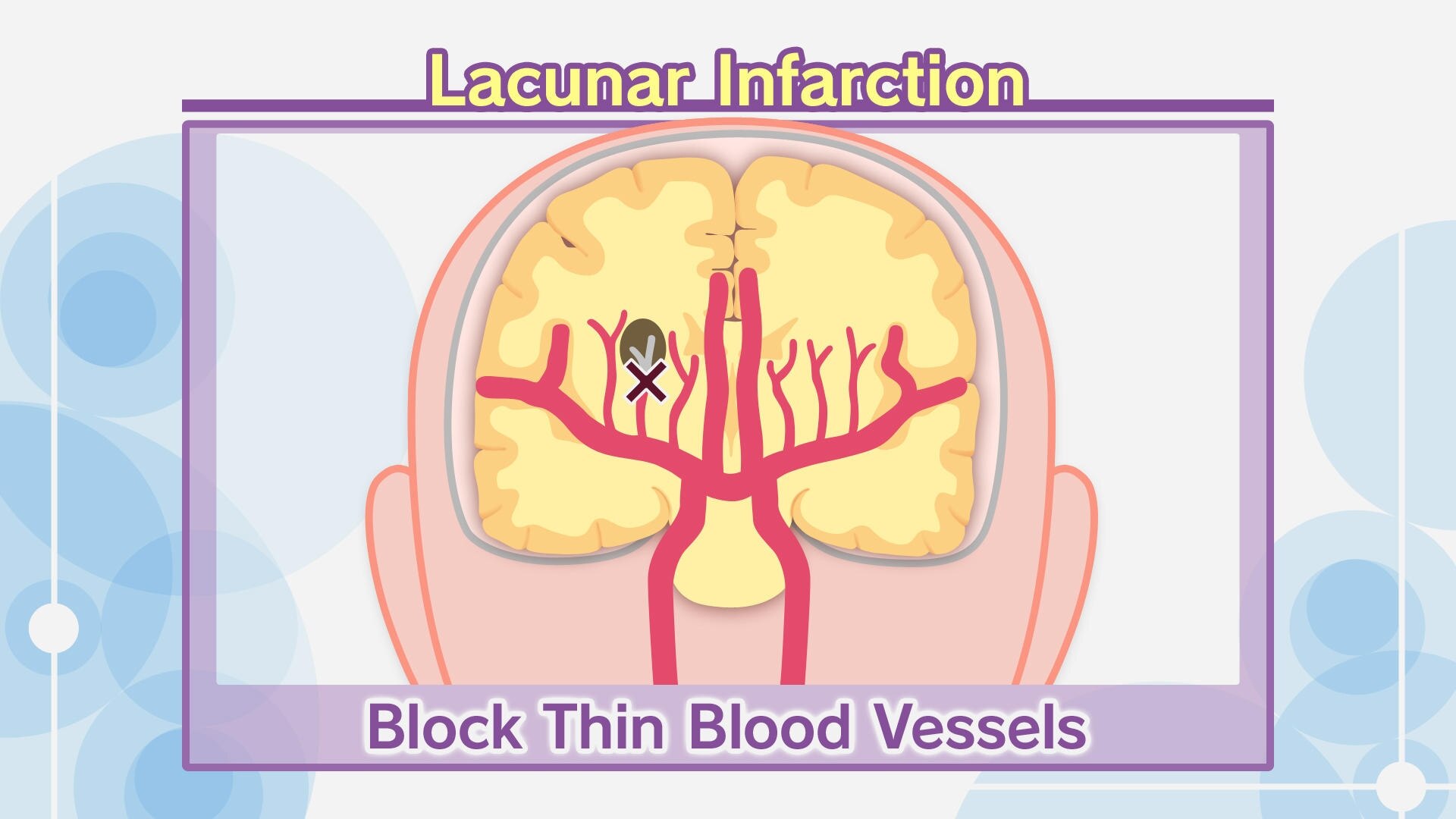 lacunarInfarction