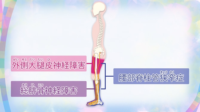 総腓骨神経障害。、外側大腿皮神経障害、腰部脊柱管狭窄症が起こる場所