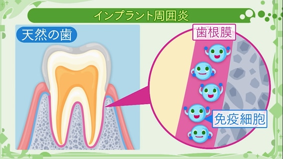 インプラントの歯周病　インプラント周囲炎のセルフケア