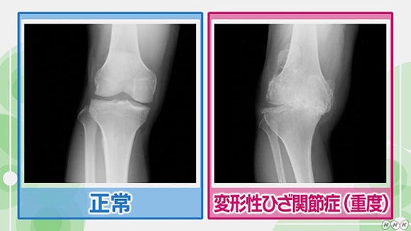 膝の腫れ 痛み 軟骨のすり減り 原因 症状チェック Nhk健康チャンネル