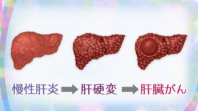 NHK健康チャンネルで確かな医療・健康情報を肝がん・肝臓がんに関する記事一覧