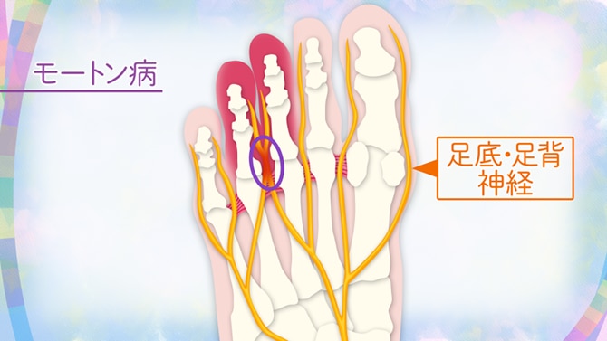足の甲・指・太ももがしびれる病気とは？原因や治療法について