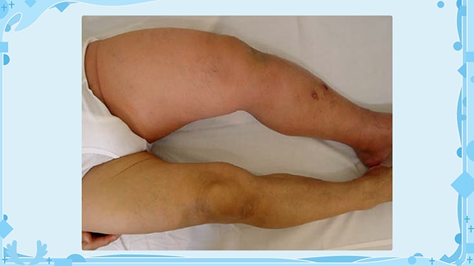 脚のむくみは病気のサイン？むくみの原因、下肢静脈瘤の手術療法