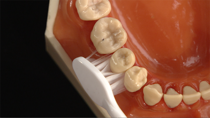 歯を守る！歯周病を防ぐ歯のセルフケア