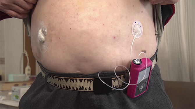 【患者体験談】低血糖をデジタルデバイスで回避
