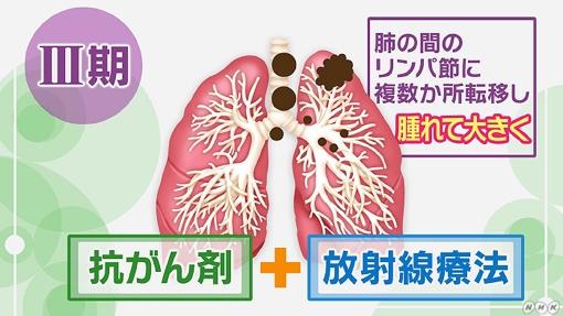 ステージで異なる肺がんの治療方法、手術・薬物療法・放射線療法とは