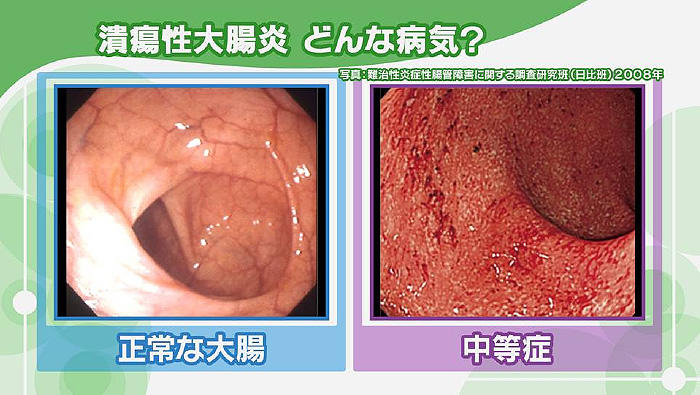 NHK健康チャンネルで確かな医療・健康情報を潰瘍性大腸炎に関する記事一覧