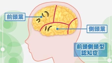 前頭側頭型認知症とは？症状や対処法・セルフチェック