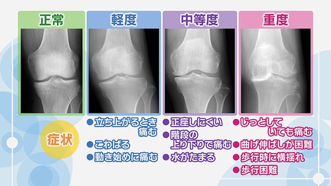 変形性膝（ひざ）関節症の進行度と症状とは（軽度・中等度・重度）