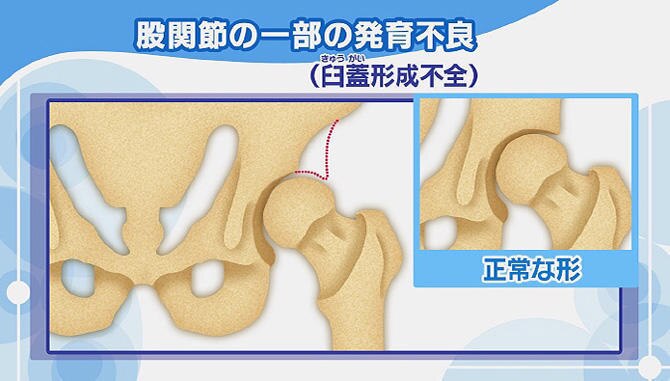 足の付け根「股関節」の痛み 変形性股関節症とは？