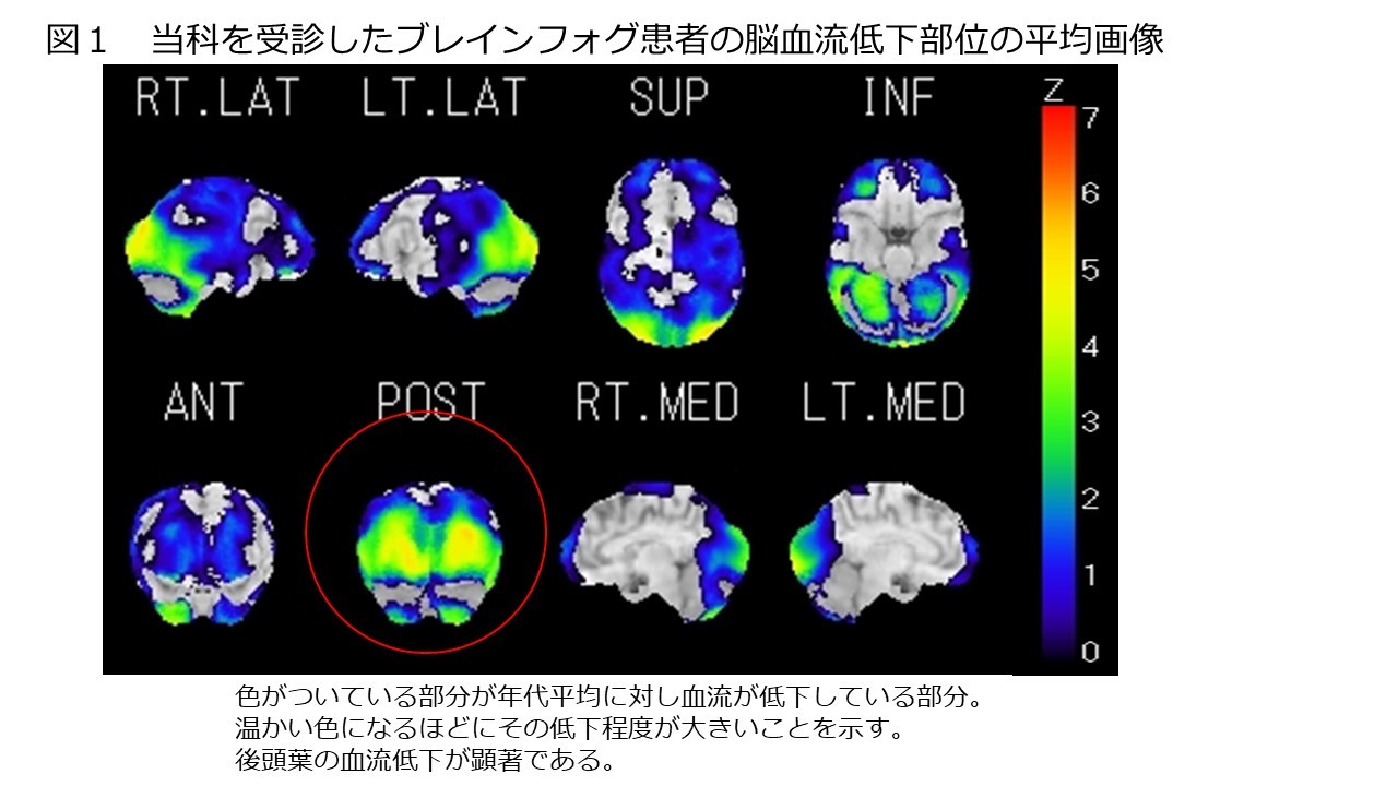 ブレインフォグ患者の脳血流低下部位の画像