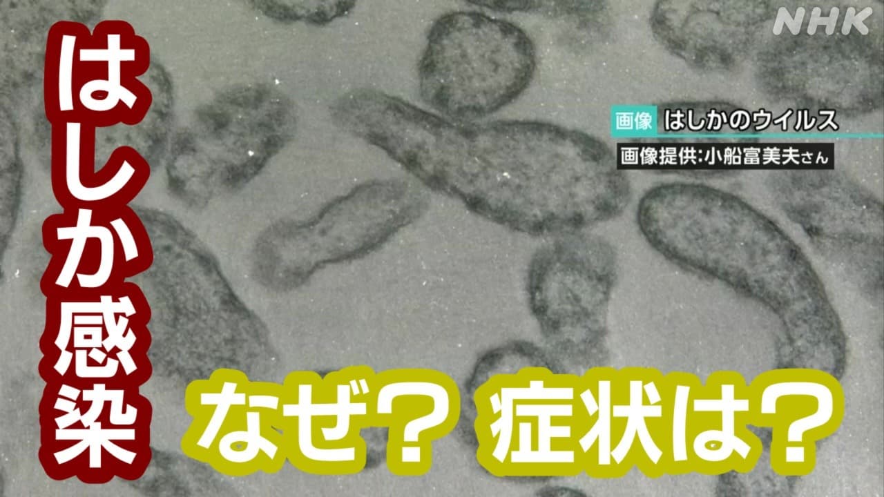 東京都内 はしか(麻疹)なぜ感染？症状や感染経路 予防接種は？