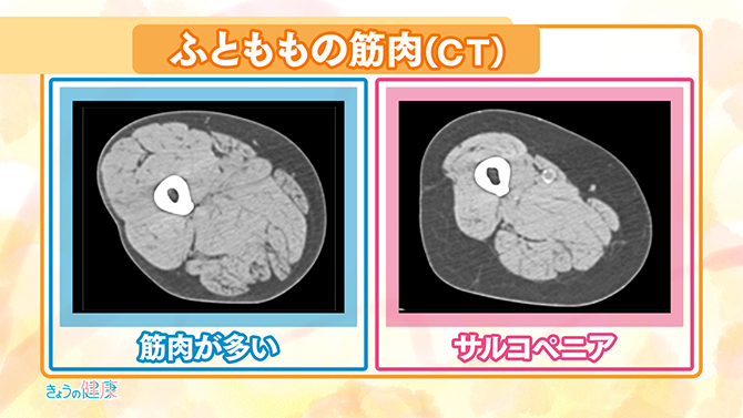 ふとももの筋肉CT画像（筋肉が多い場合とサルコペニアの比較）