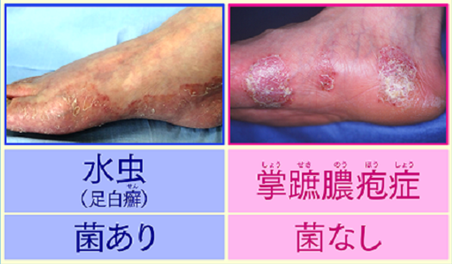 水虫に似た皮膚炎　掌蹠膿疱症とは？　検査や効果的な薬について